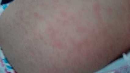 宝宝爱长疹子是免疫力差吗,宝宝爱长疹子适合喝什么奶粉