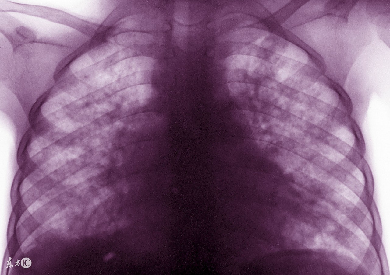 耐药性肺结核中医该吃什么,中医能治好肺结核钙化灶吗