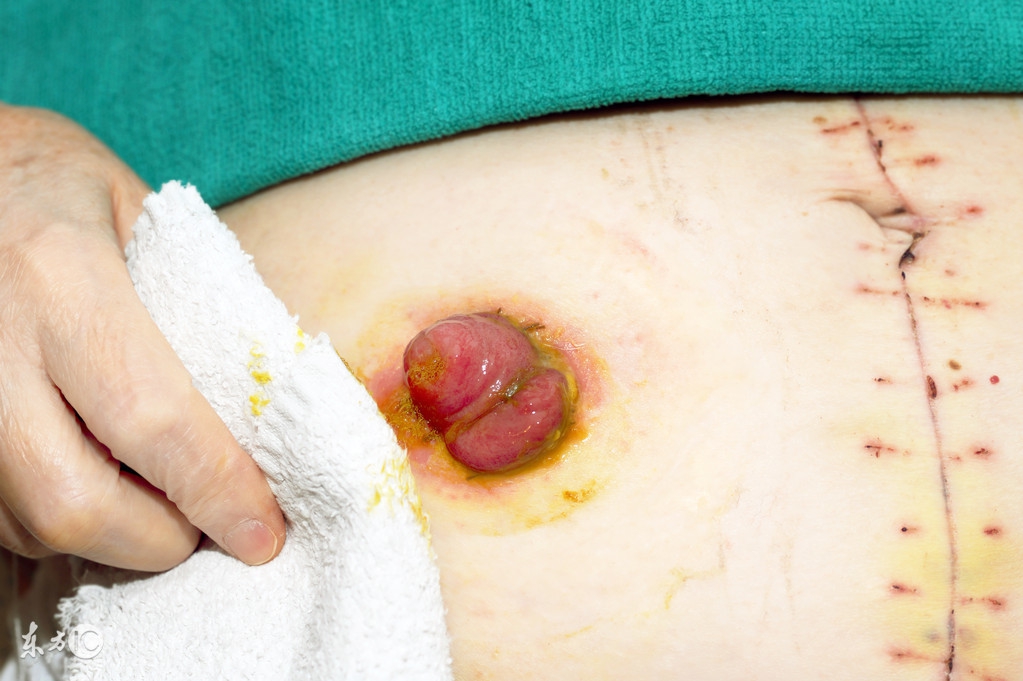 什么原因结肠异常扩张,结肠在什么情况下胀的慌