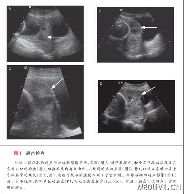 胎盘不正什么意思,胎盘不正为什么要住院