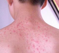 后背经常起疙瘩痘痘怎么回事,后背皮肤会长疙瘩