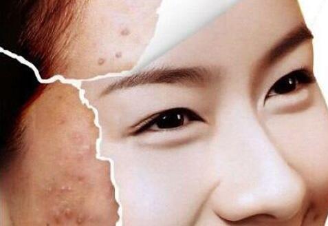 光子嫩肤痘印去不掉啊,做完光子嫩肤痘印加深