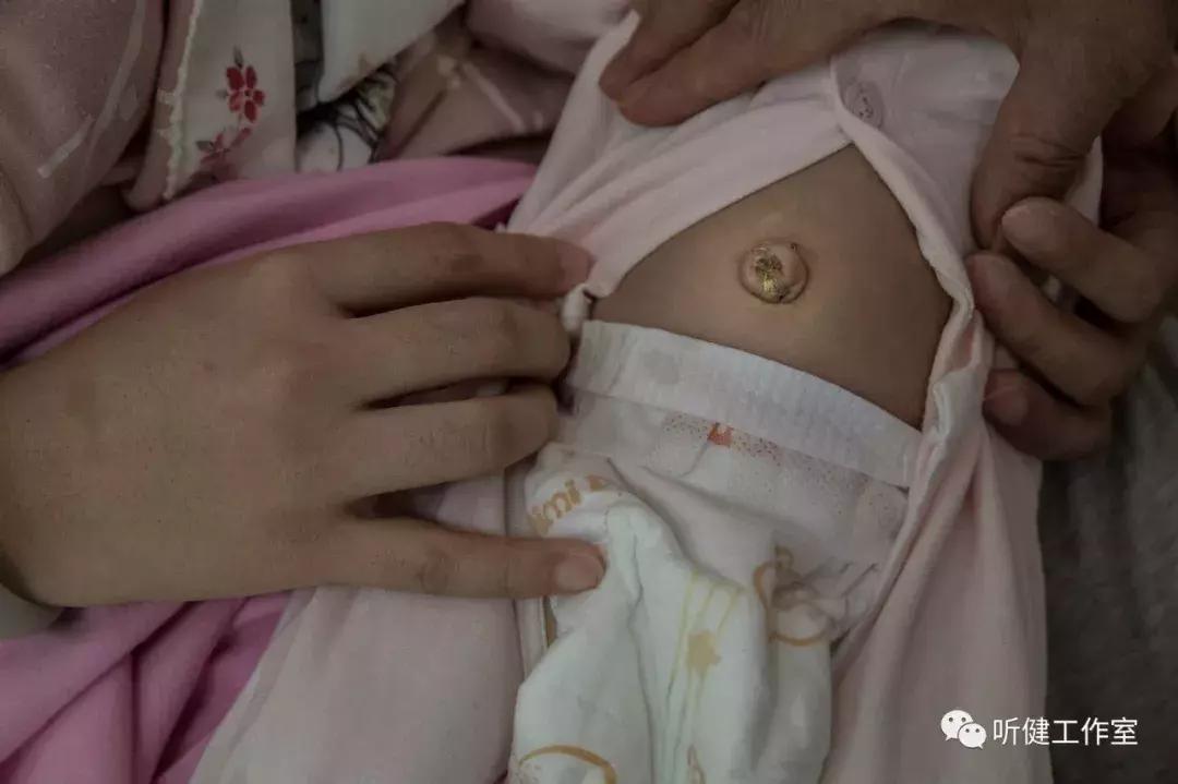 一只受伤的手指头,一只手指创造了奇迹