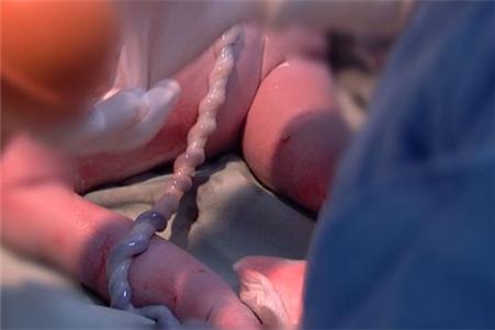 胎儿太顽皮脐带被扭成“麻花状”，幸亏妈妈这个习惯救他一命