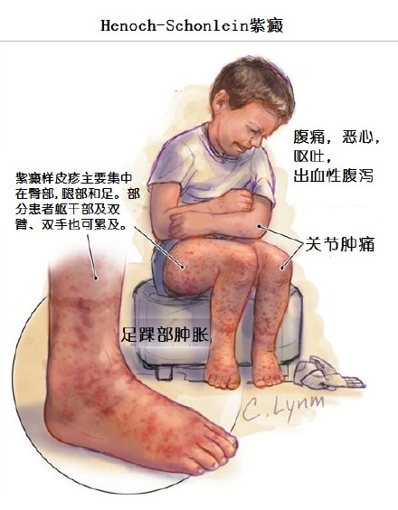 儿童过敏性紫癜激素的使用指征,过敏性紫癜激素治疗会终身胖吗