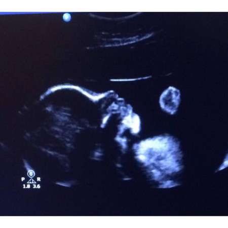 准妈妈看过来孕期瑜伽,孕期b超知识大全