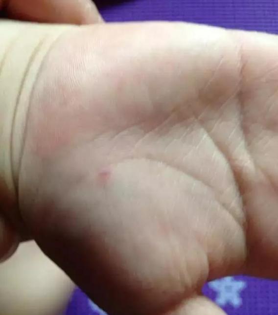 手足口病高发期勤洗手很重要,手足口勤洗手