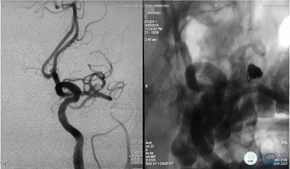 脑动脉瘤并颈动脉狭窄怎么治疗,脑动脉血管狭窄介入治疗效果好吗