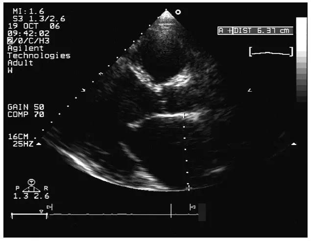 心脏扩大有什么症状和后果,心脏扩大症