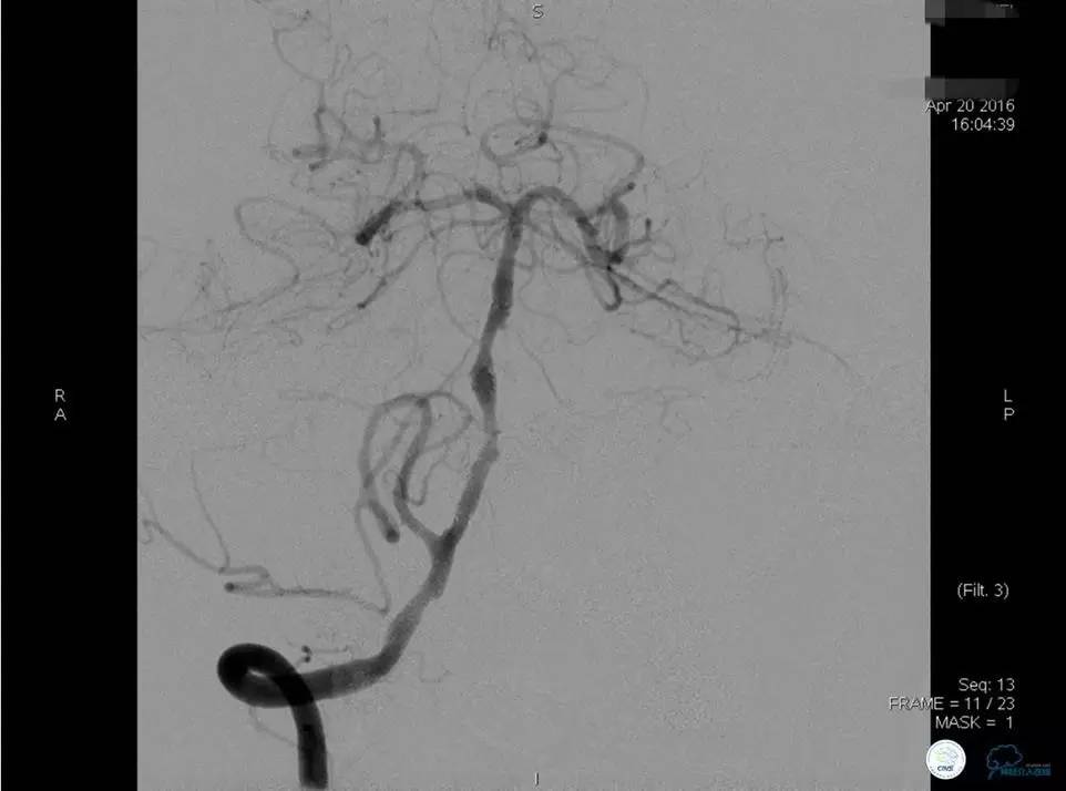 颅内动脉狭窄介入治疗研究,颅内血管cta副作用