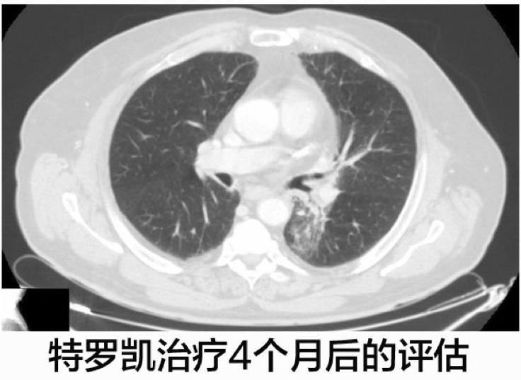 化疗失败后靶向药有效的案例,肺腺癌egfr突变耐药化疗