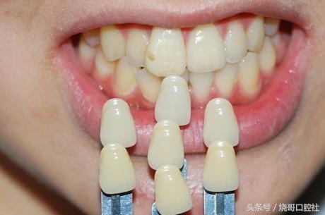 戴牙冠哪种材料便宜对人体无害,种植牙后牙冠用什么材料好