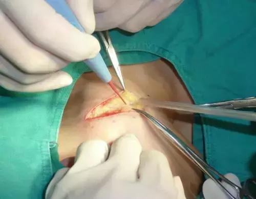 食管癌术后饮食宣教视频,食管癌手术术前一天饮食