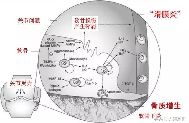 滑膜炎是肌肉还是骨头的问题,滑膜炎是不是类风湿的一种