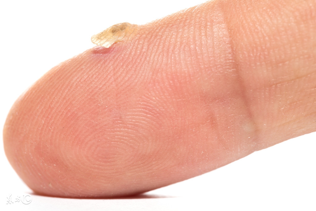 分析扁平疣突然很痒的原因以及扁平疣痒时该怎么办