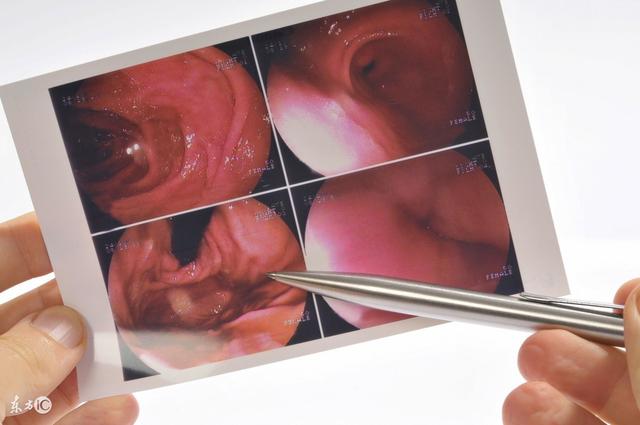 胃镜检查很痛苦吗,胃镜检查幽门螺旋杆菌准确吗