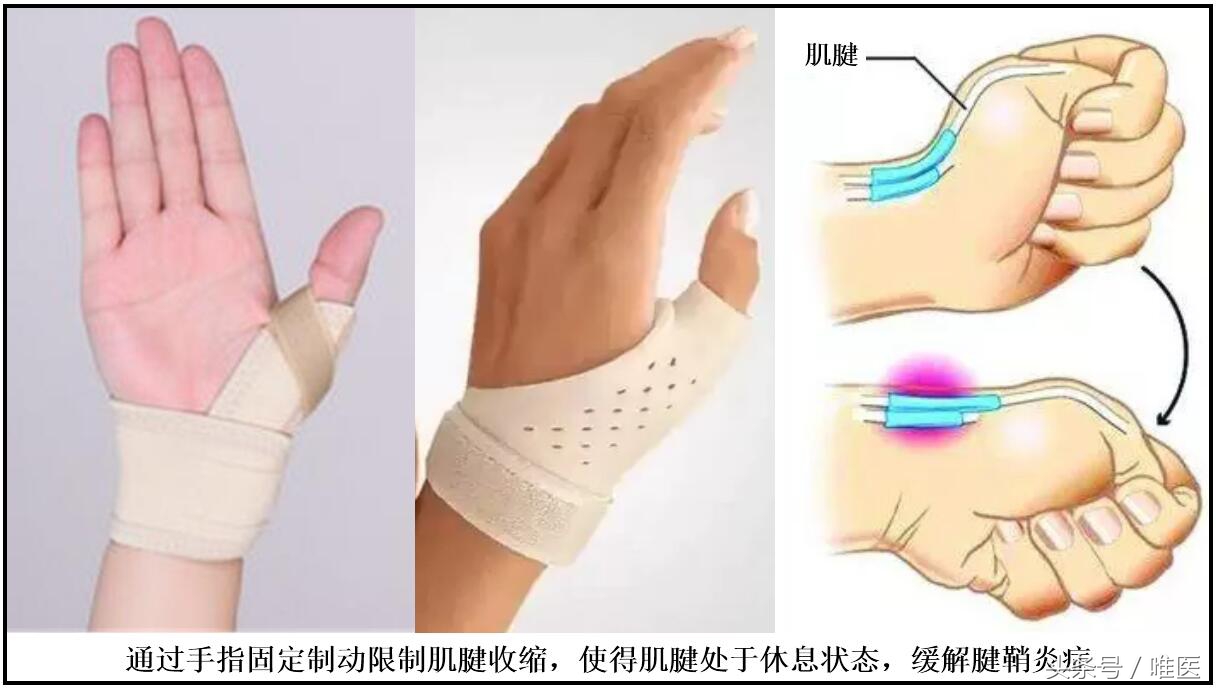 腱鞘炎治疗过程疼到尖叫视频,腱鞘炎跳一跳