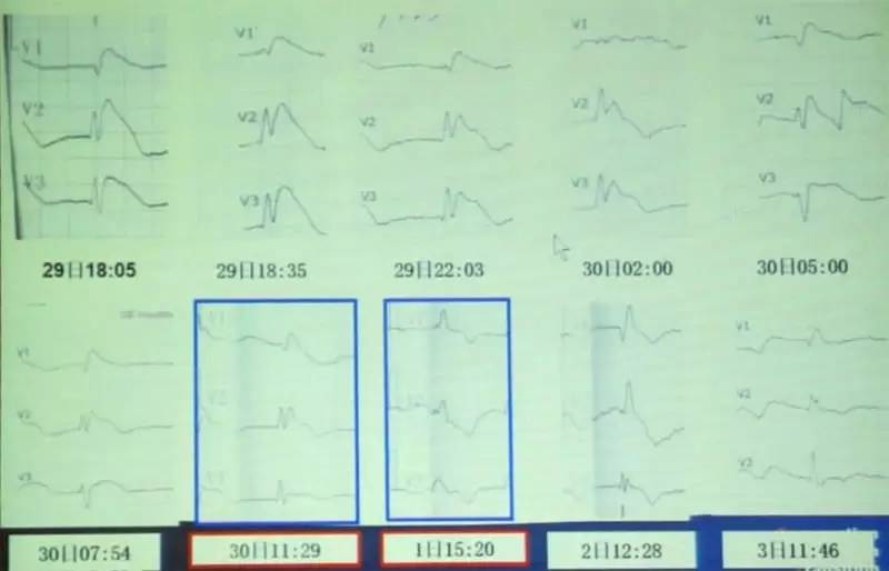 brugada三种形态的心电图,心电图查出brugada混合型严重吗