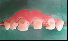 乳前牙预成冠补牙过程,乳前牙龋坏修复