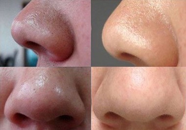 鼻尖黑头严重是什么原因,鼻尖上有黑头是怎么回事