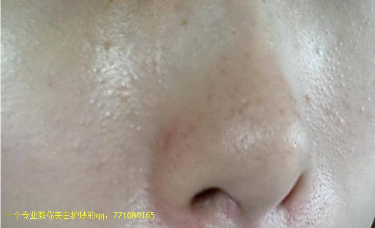 白头粉刺怎么去除鼻子脸颊,白头粉刺怎么去除背部