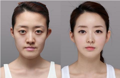 值不值得去韩国整容,韩国整容比中国便宜吗