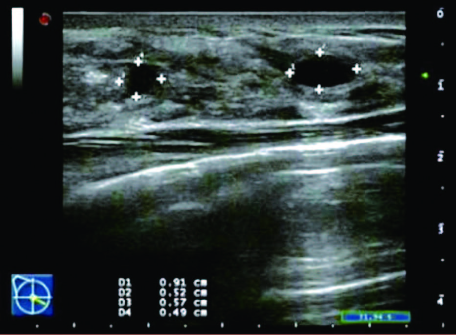 乳腺增生3级结节严重吗,女性乳腺增生怎么治最好