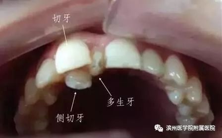 小孩的牙齿过长牙缝过大怎么办,牙齿有牙缝对孩子有影响吗