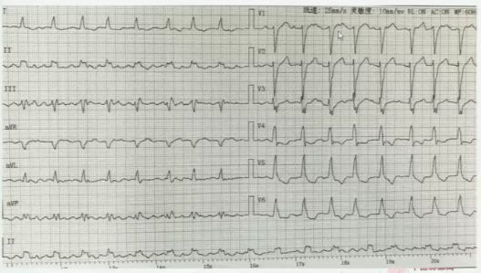 郑大一附院心血管内科专家陈英伟,房颤的治疗策略及进展