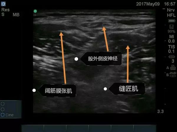 超声引导隐神经阻滞视频教学,超声引导下腰椎旁神经阻滞视频
