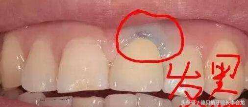 烤瓷牙表面掉瓷了对人身体有害吗,小加工厂做的烤瓷牙对身体有害吗