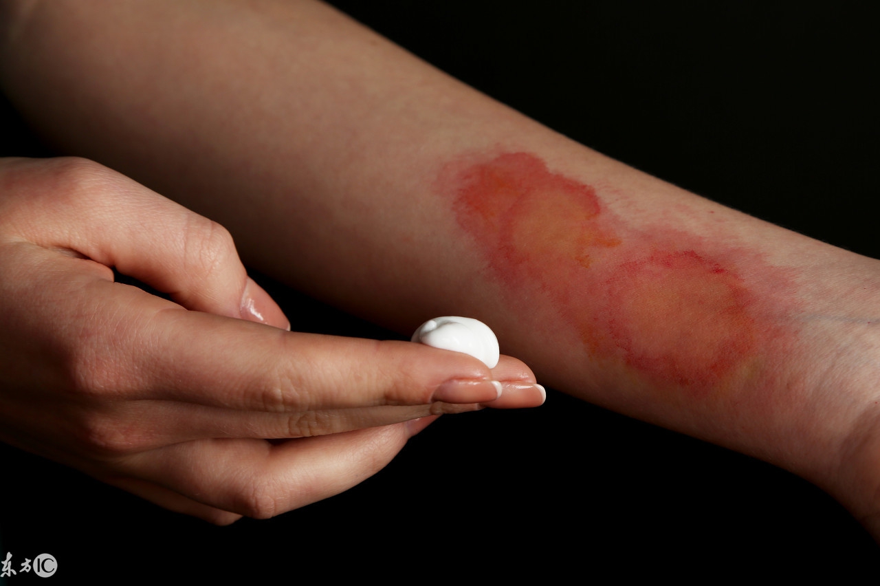 大人被开水烫伤怎么处理好得快,烫伤后可以涂牙膏蜂蜜酱油吗