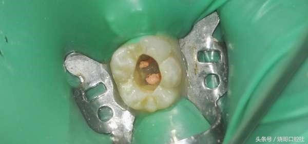 牙神经死掉牙齿发黑,五岁儿童牙神经坏死牙发黑怎么办