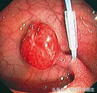 爸爸有肠息肉儿子也有是遗传吗,自己长肠息肉会遗传到孩子吗