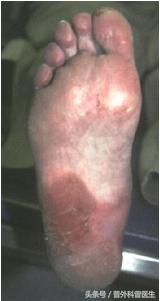 大肠癌化疗后抽血注意事项,大肠癌化疗完手无血色是咋回事