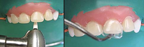 乳前牙预成冠补牙过程,乳前牙龋坏修复