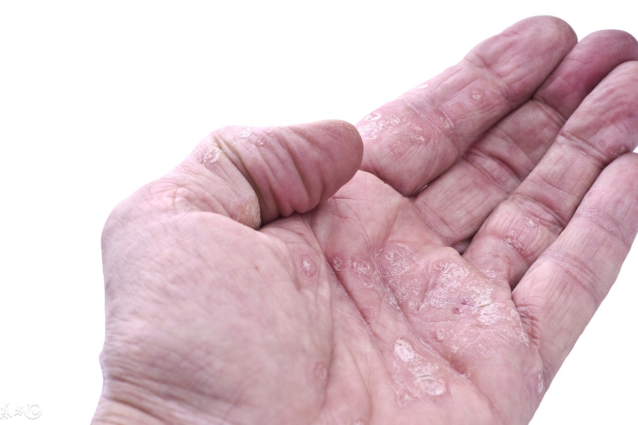 复方阿维a治疗银屑病副作用,只需3味药治愈银屑病