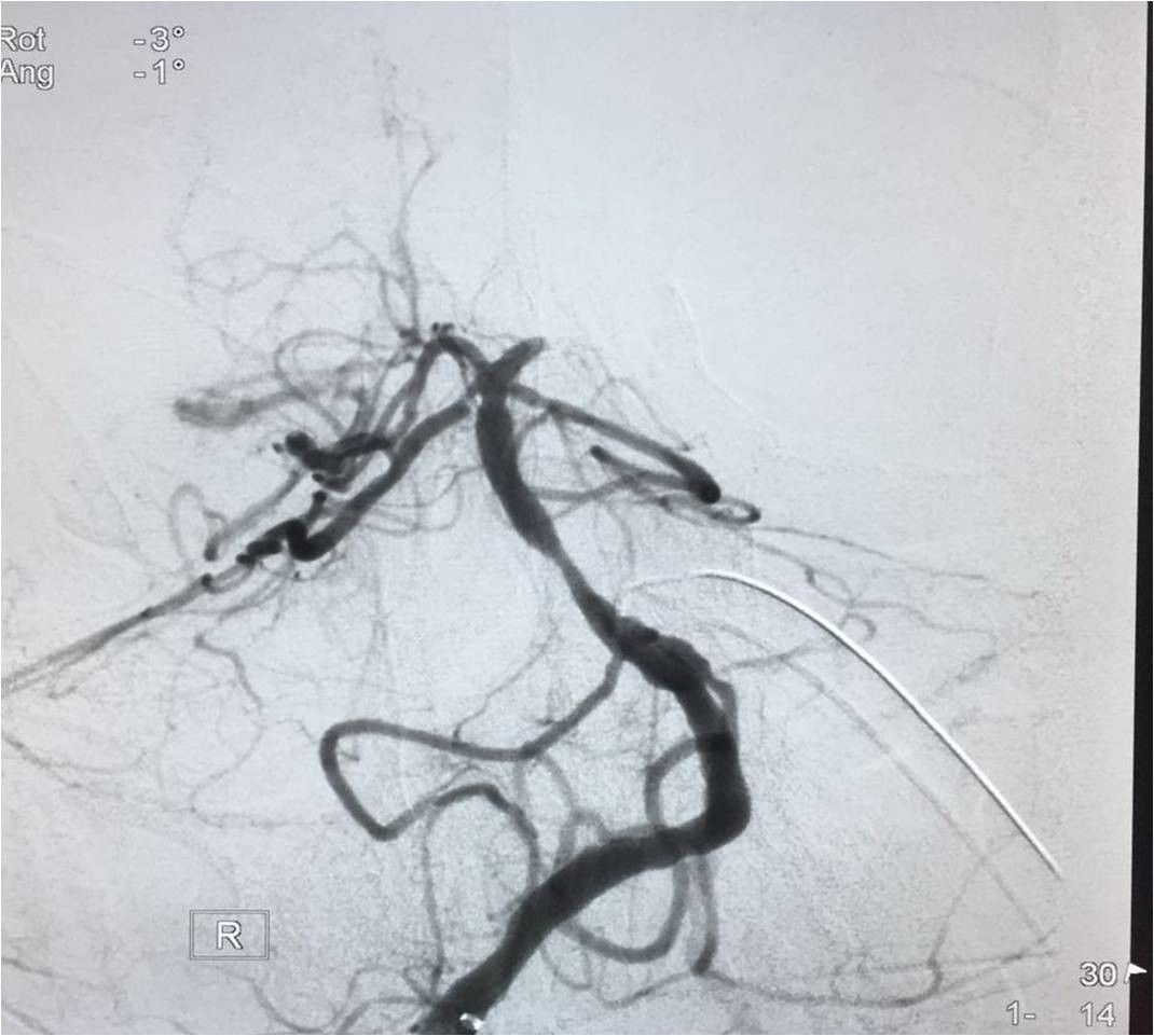 取栓慢性闭塞如何避免血栓逃逸,急性大脑中动脉栓塞取栓时间