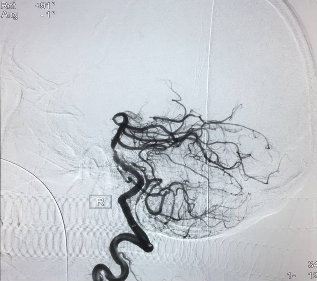 取栓慢性闭塞如何避免血栓逃逸,急性大脑中动脉栓塞取栓时间