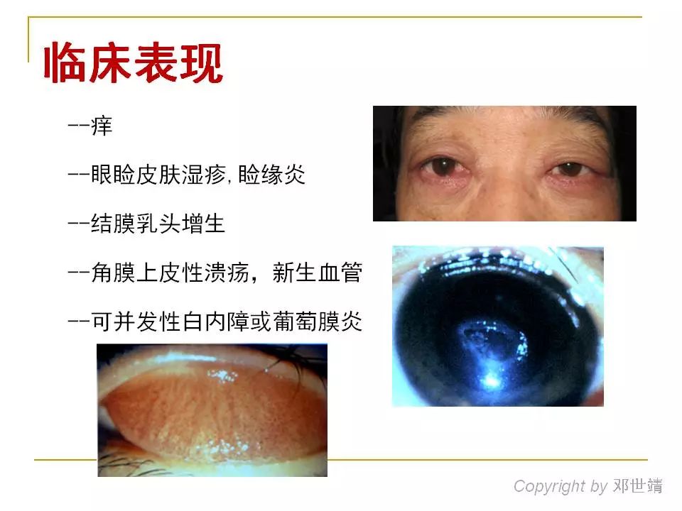 眼周过敏中医治疗,眼周过敏的症状图片