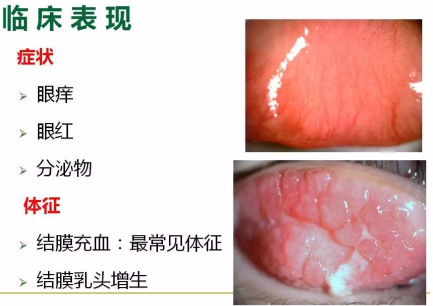 眼睛过敏如何预防,治疗眼周围过敏方法