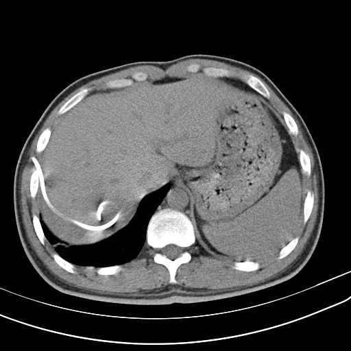 如何通过肺ct看出自己得了肺炎,肺ct怎么看出是病毒还是细菌
