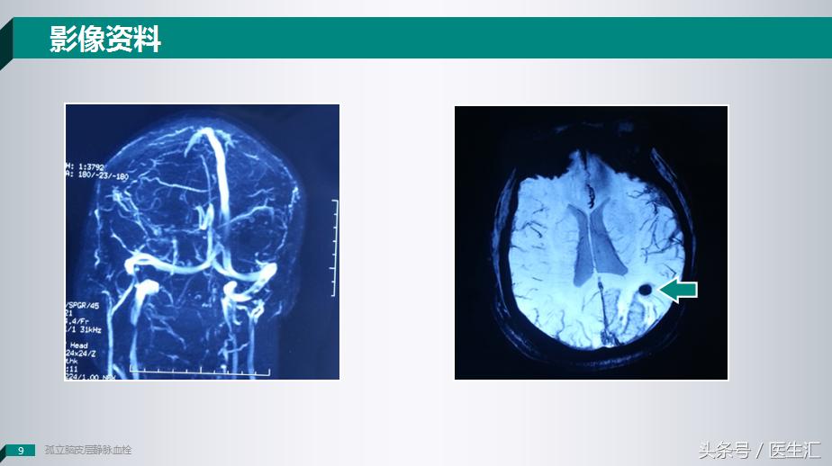 各项检查正常总感觉自己有病,轻度意识障碍是什么