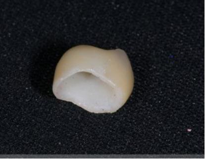 北京口腔医院修复科王淑英,补牙全冠和嵌体的哪个好