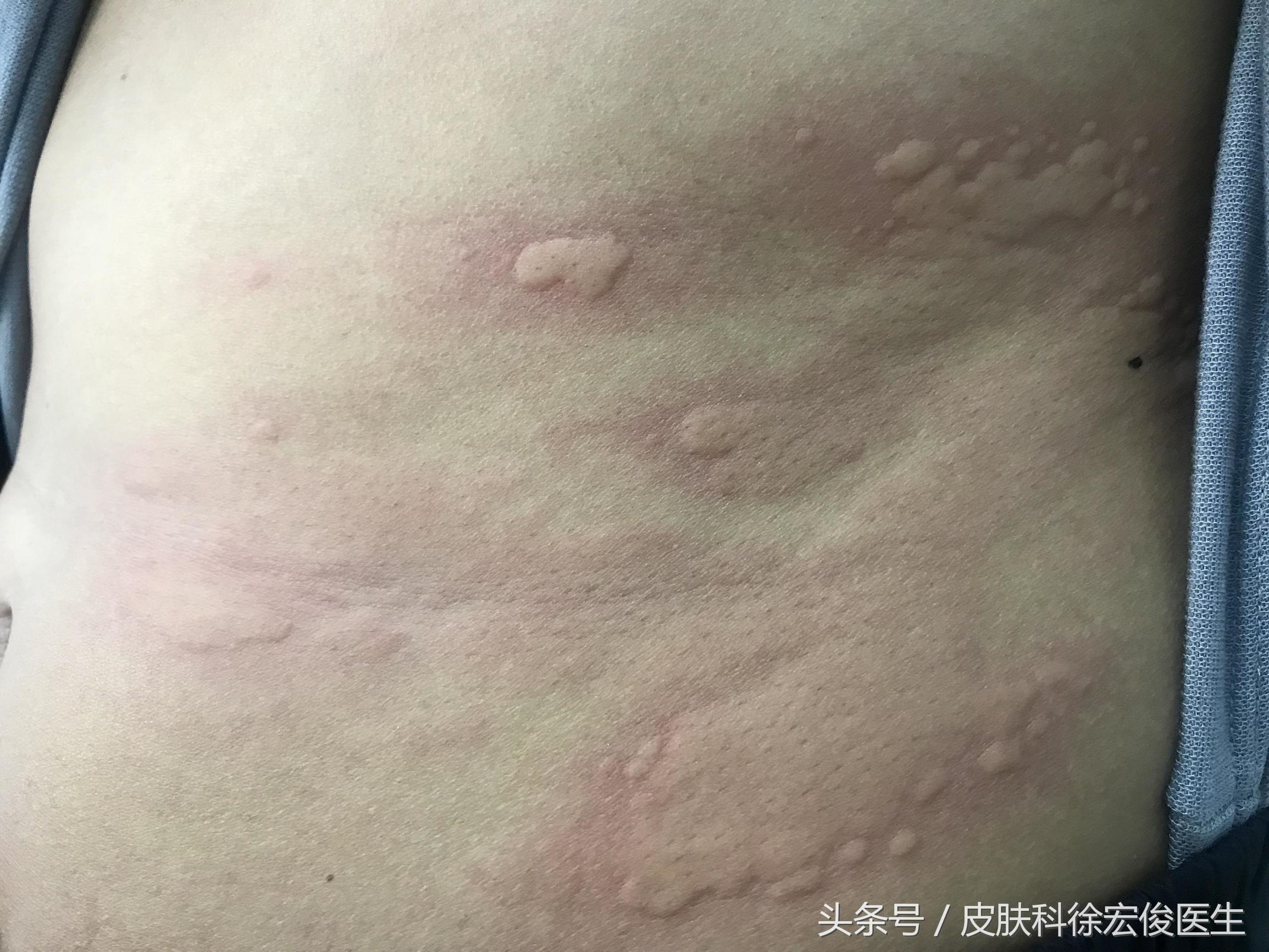 激素没有那么可怕,激素是不是根本不治病