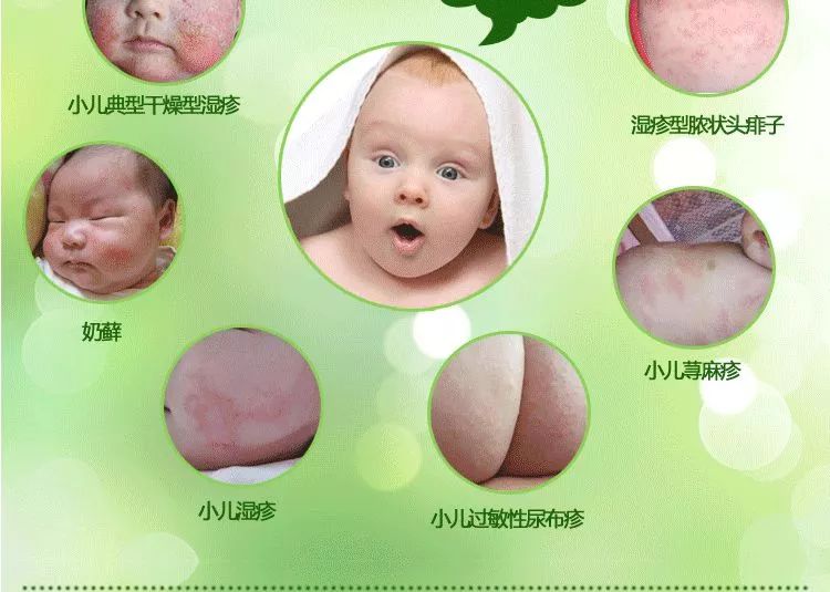 宝宝湿疹用药有讲究！反复发作怎么办？教你八招轻松搞定