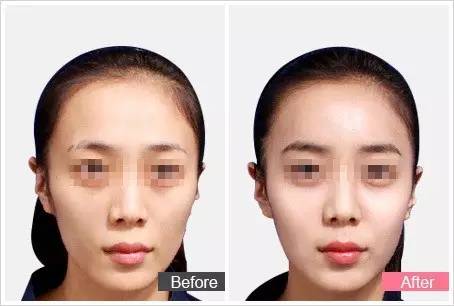 自体脂肪填充川字纹保持多久,自体脂肪填充10天内效果图