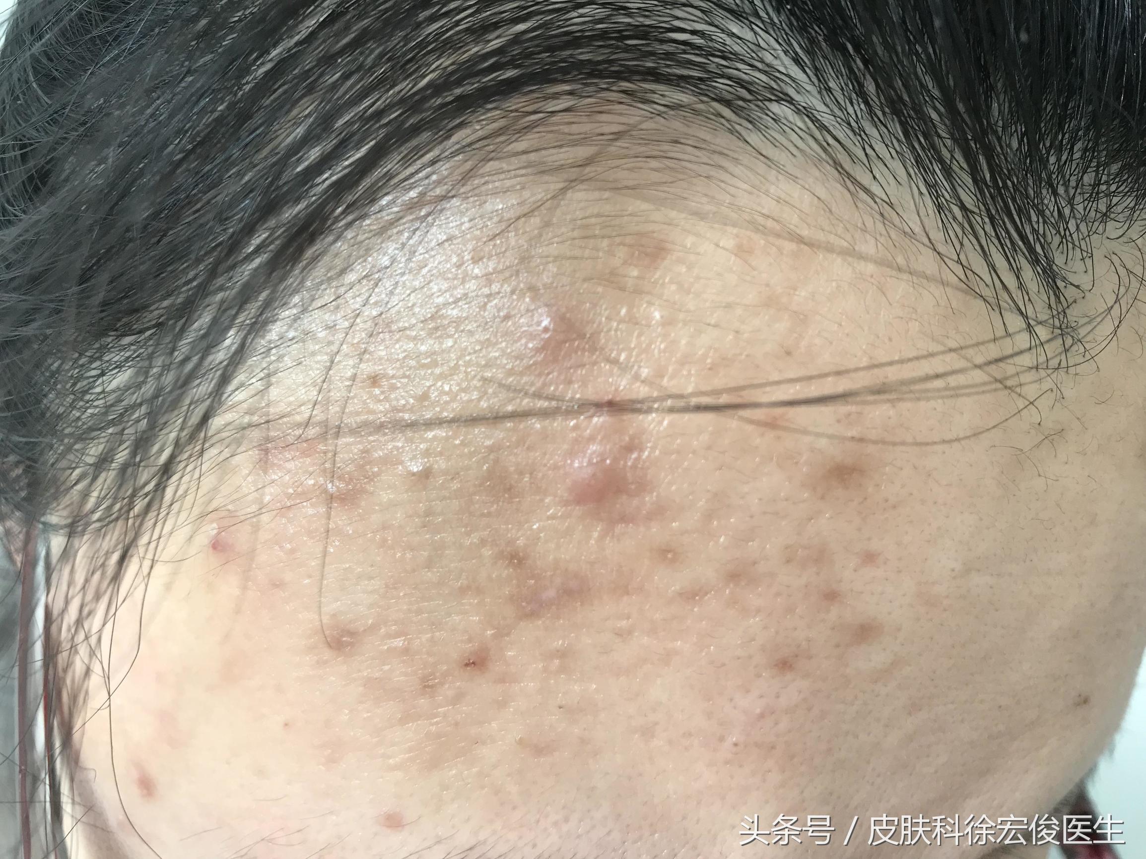 关于皮肤问题服用的激素药有哪些,激素皮肤病能根治吗