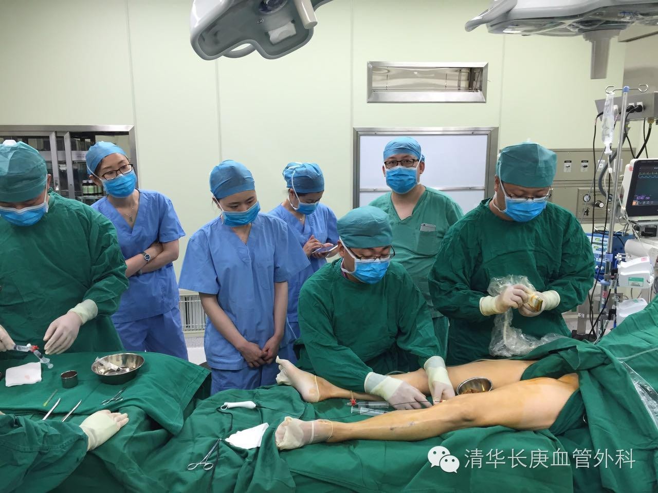 北京医院静脉曲张微创手术,清华长庚静脉曲张