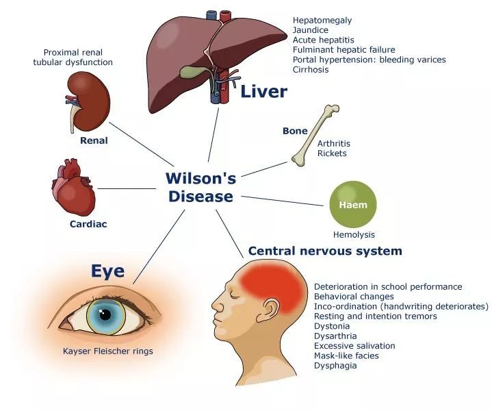 小儿肝豆状核变性患者样子,肝豆状核变性的孩子寿命短吗
